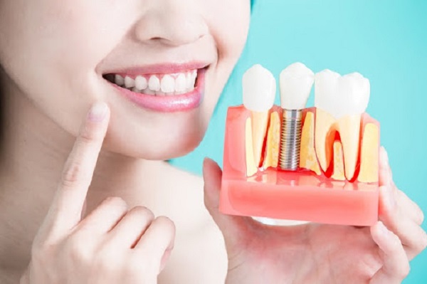 Implant Surgic XT Plus giúp hồi phục răng mới với công năng như răng thật